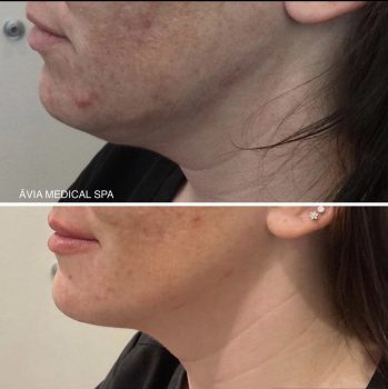 Results after 1st treatment of Kybella